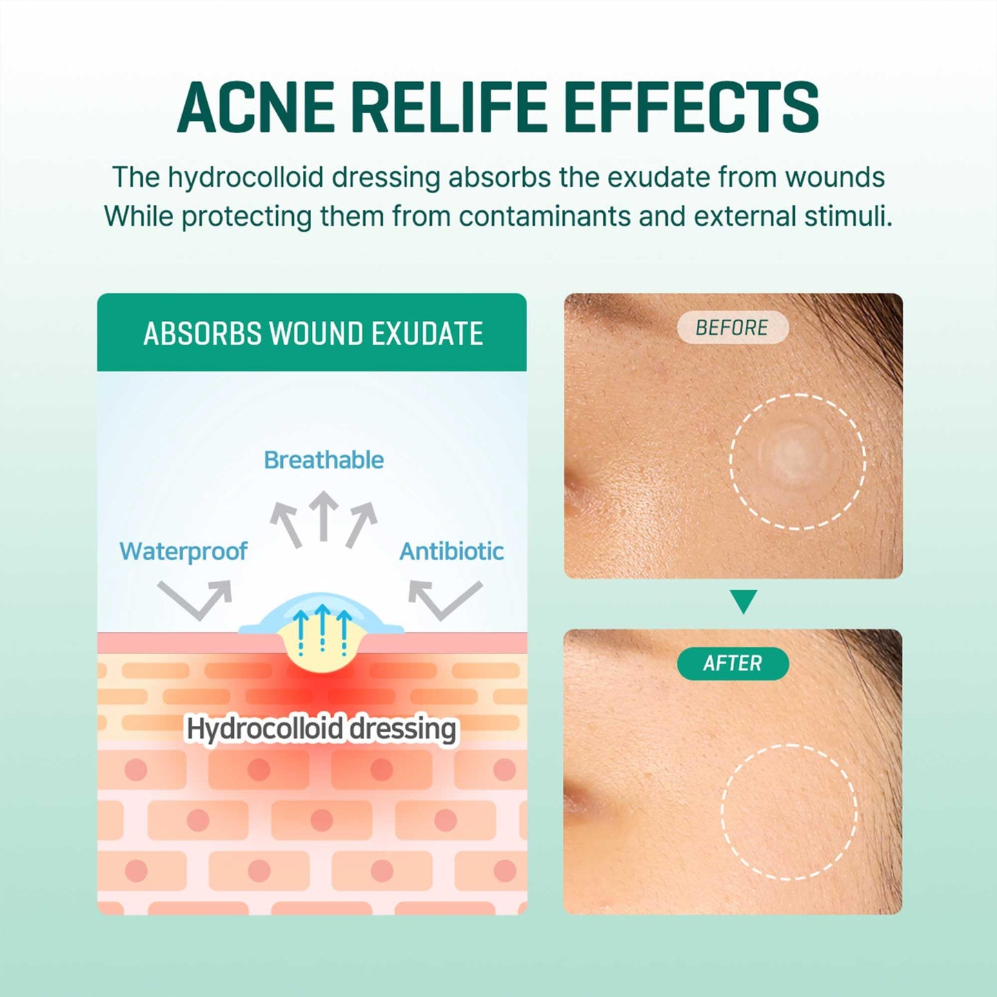 30 Days Miracle Clear Spot Patch [18 pcs] - SOME BY MI